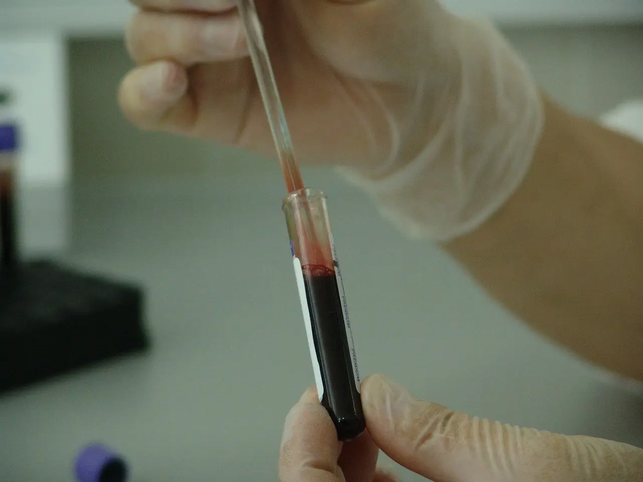 Proteine din sânge pot prezice cancerul de prostată cu zece ani înainte