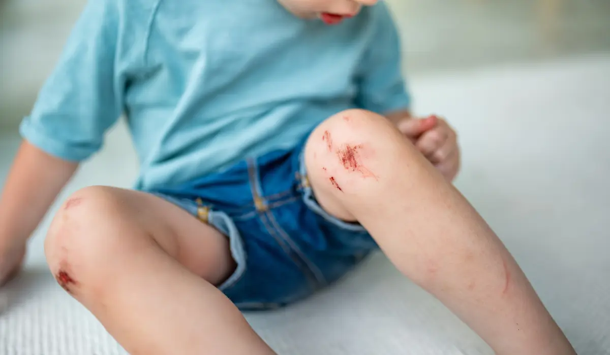 Celulita la copii: semnele care arată că o răniță simplă devine infecție gravă