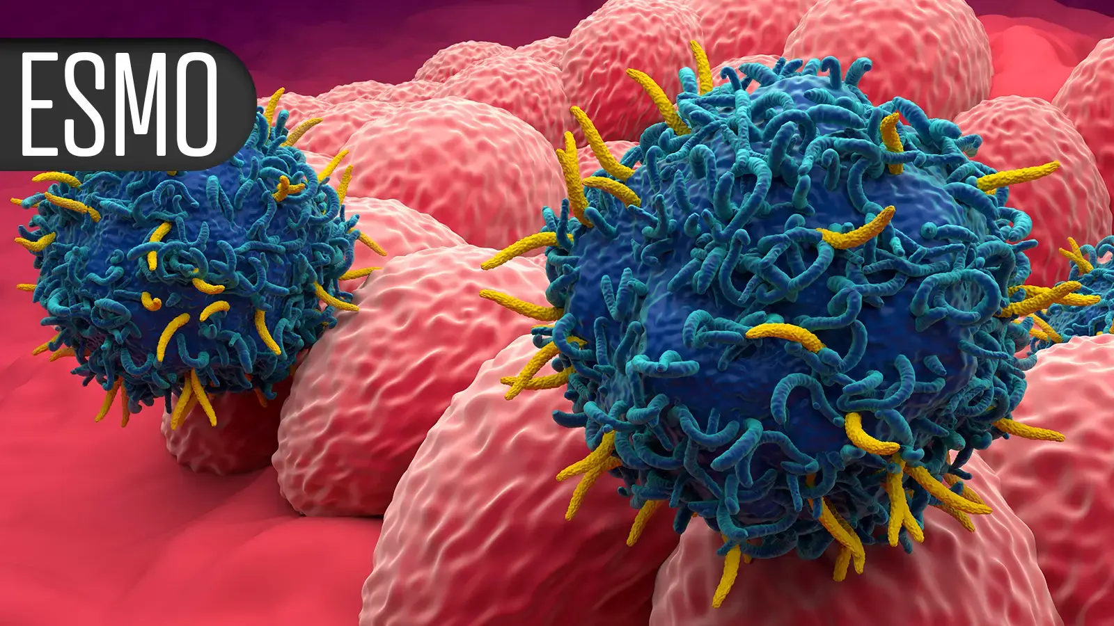 Pembrolizumab fără chimioterapie dublează supraviețuirea fără progresie în cancerul endometrial dMMR