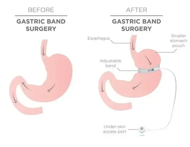 Obezitatea slăbește imunitatea, dar chirurgia bariatrică o repară