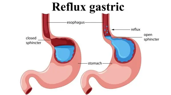 Oțetul de mere pentru reflux: alinieră sau agraver?