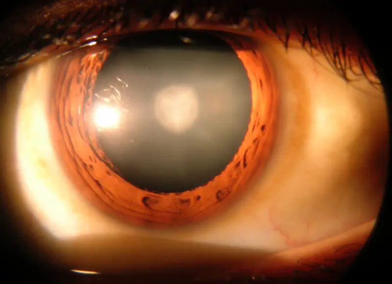 Psoriaza crește riscul de cataractă: ce ar trebui să știi