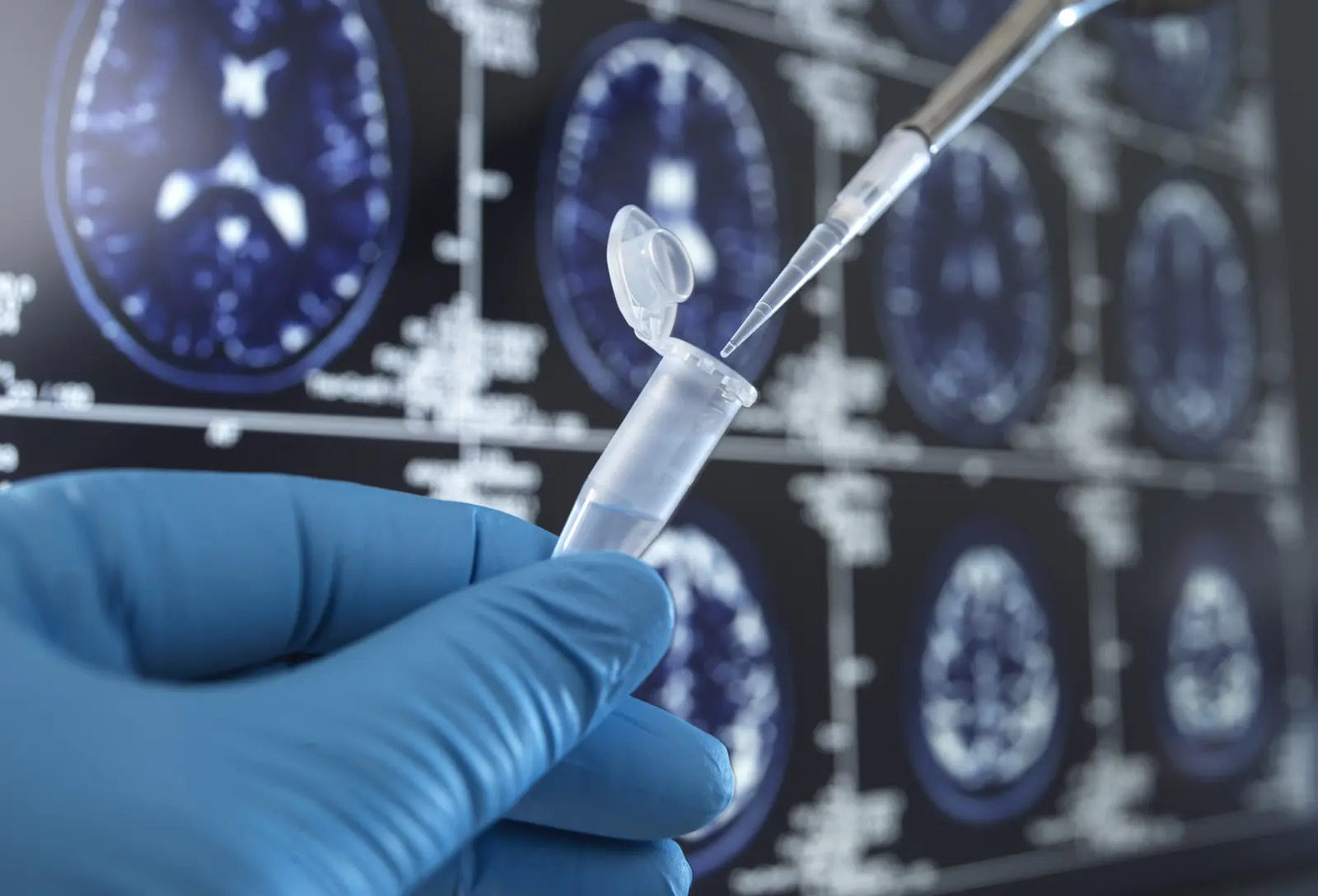 Vaccinul BCG ar putea proteja creierul de demență, susțin cercetătorii